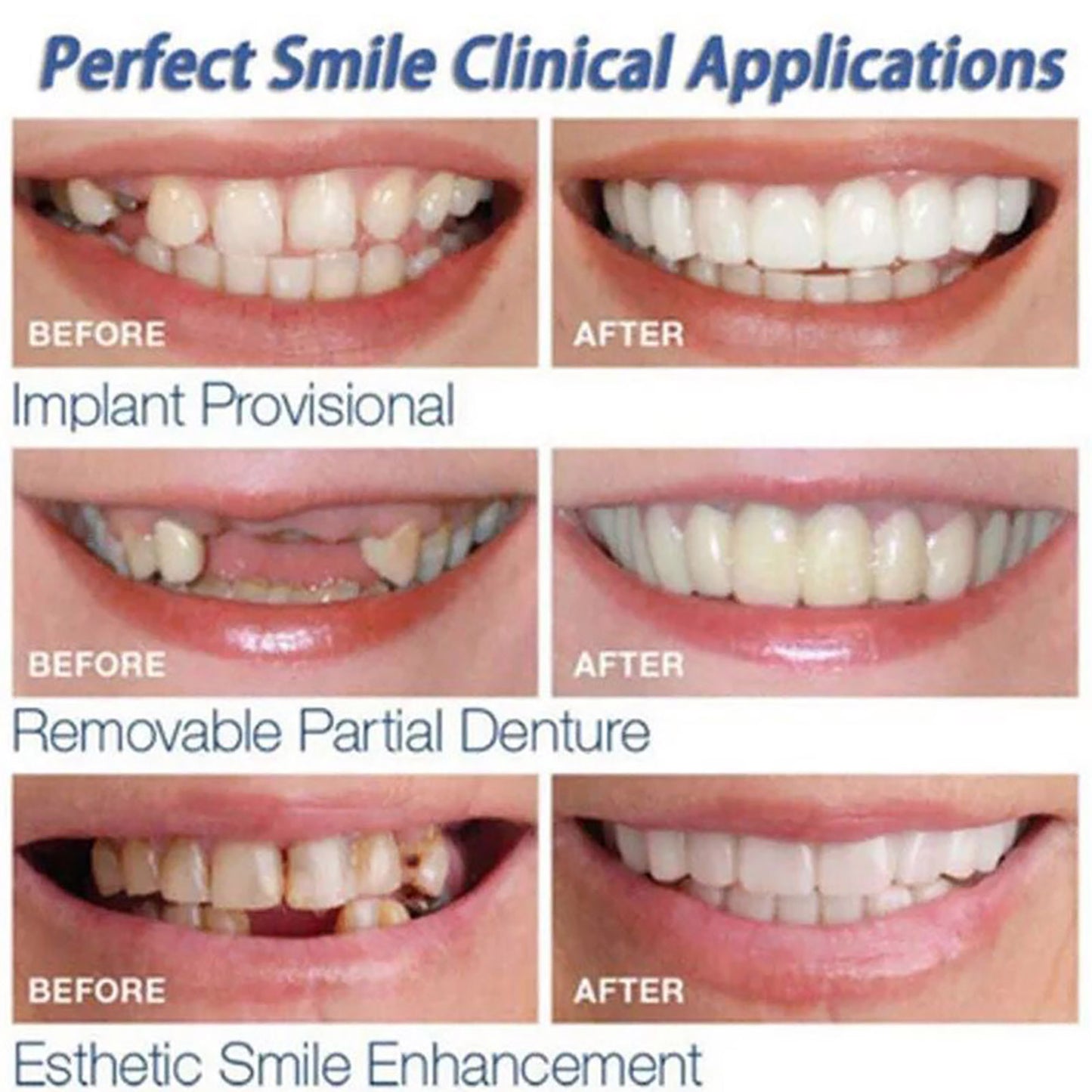 Luce sonrisa nueva HOY  Carillas dentales con 50% OFF por tiempo limitado